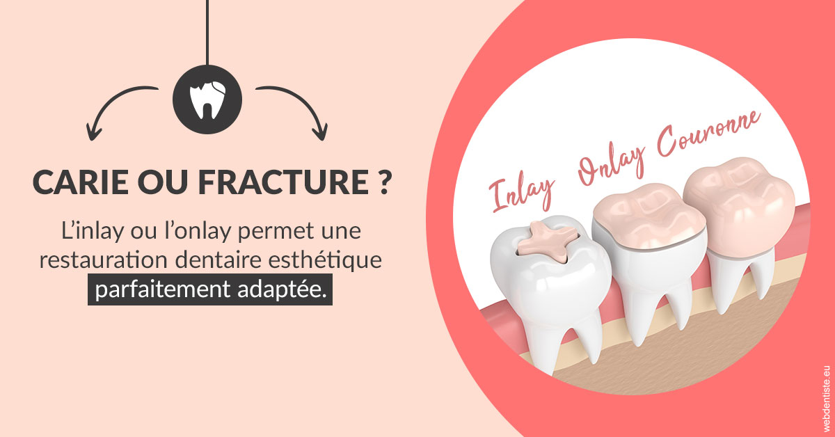 https://dr-bonnel-marc.chirurgiens-dentistes.fr/T2 2023 - Carie ou fracture 2