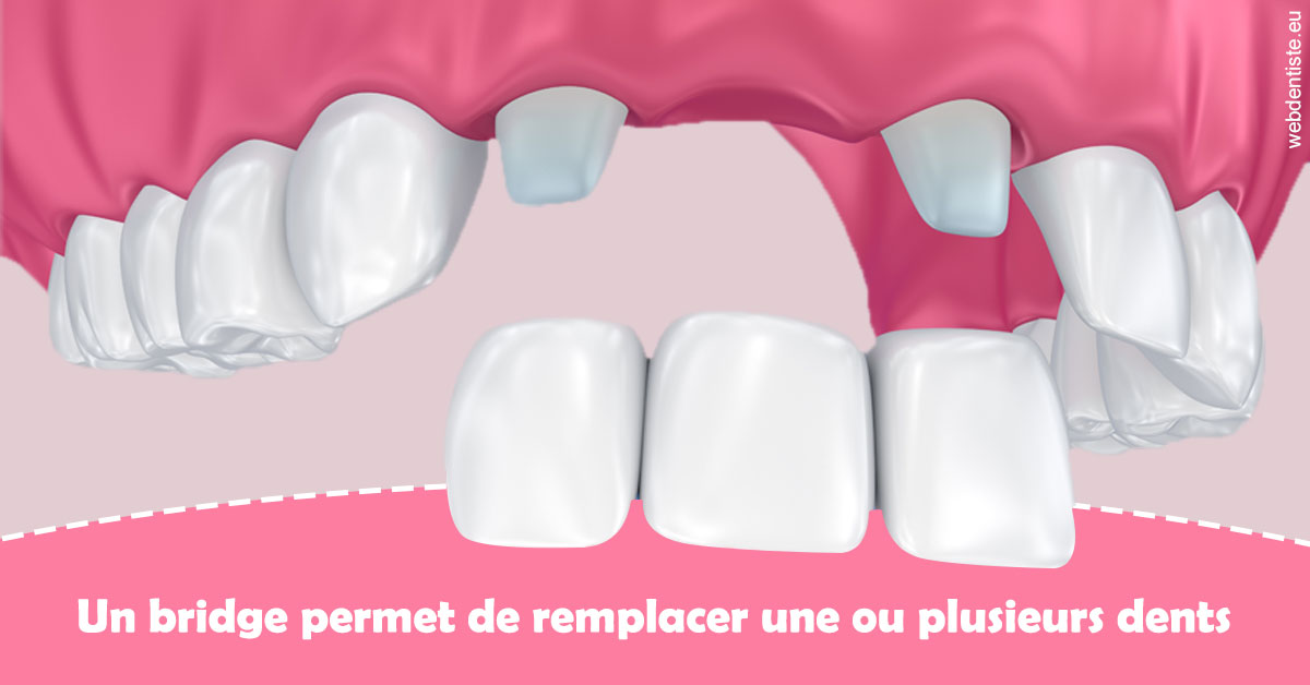 https://dr-bonnel-marc.chirurgiens-dentistes.fr/Bridge remplacer dents 2