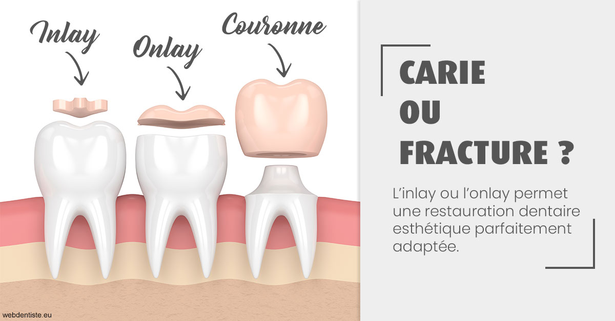 https://dr-bonnel-marc.chirurgiens-dentistes.fr/T2 2023 - Carie ou fracture 1